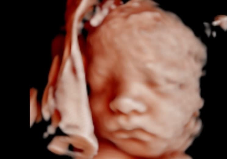 Ultrasound image