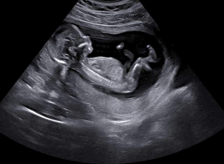 Ultrasound image