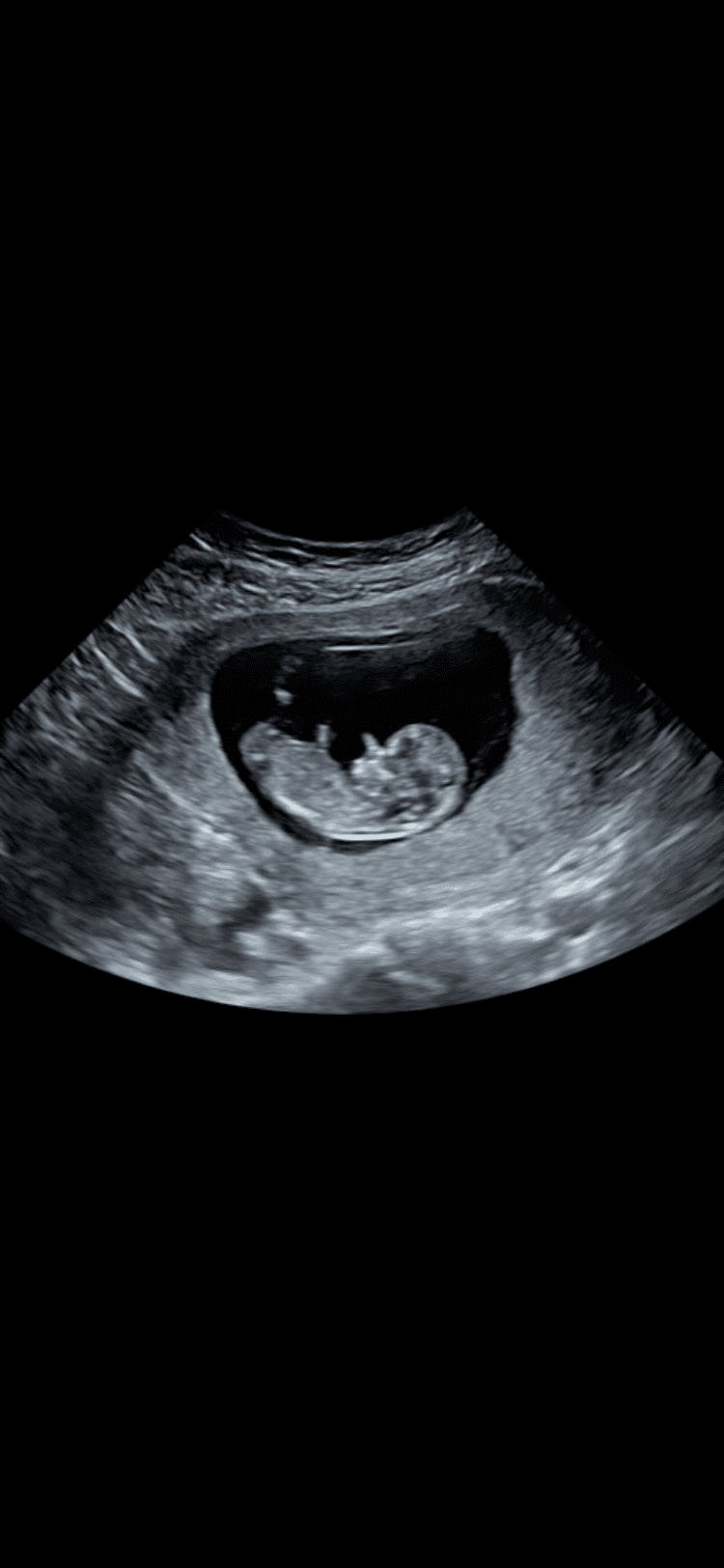 Ultrasound image