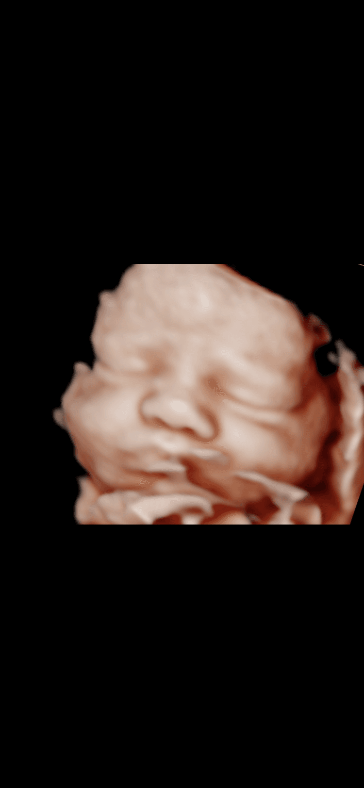 Ultrasound image