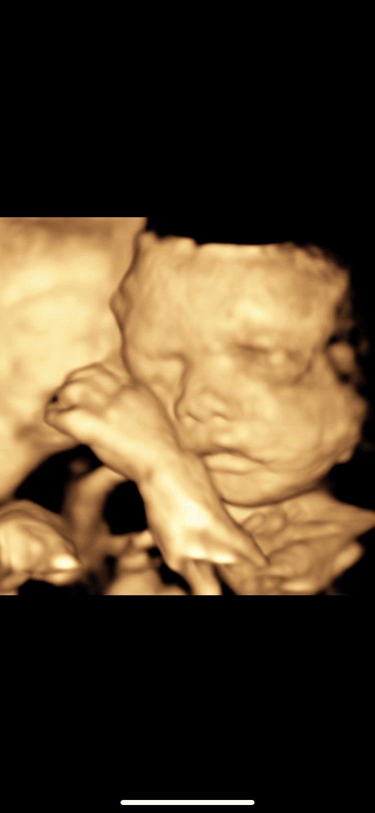 Ultrasound image