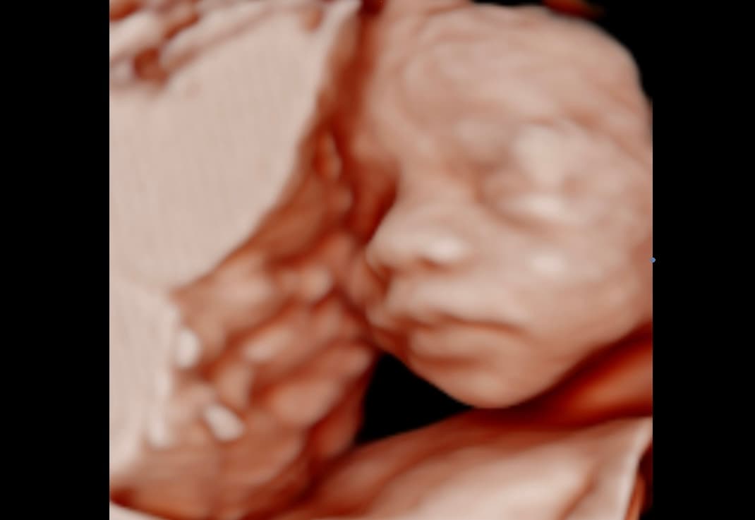 Ultrasound image
