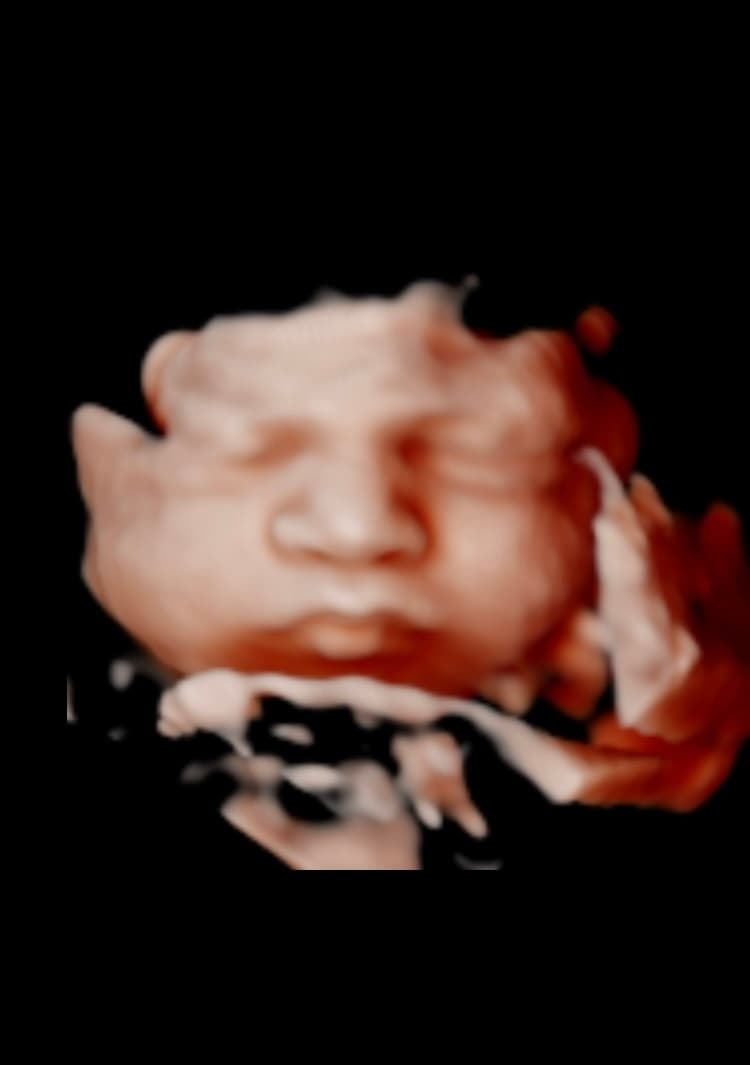 Ultrasound image